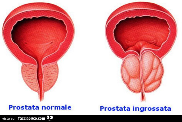 La prostata